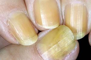 Лечим онихомикоз ногтей в домашних условиях Онихомикоз ногтей лечение в домашних